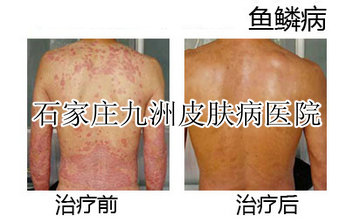 鱼鳞病治疗对比图