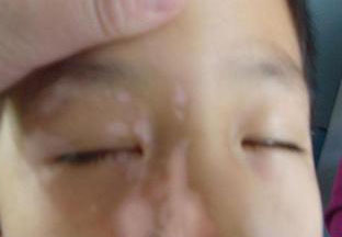 浮肿型白癜风是怎么回事呢