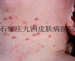 患者怎样正确的对待扁平疣的危害?
