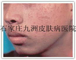 ƽβܳ׵hpv?