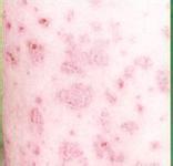 ƽ༤ƺӦԸhpv?