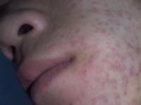 ƽΪʲôƲܳȥhpv?