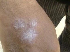 牛皮癣患者如何才能够尽快的消除瘙痒的伤害呢?