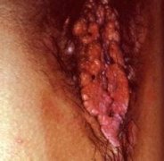 ʪٴβܳ׵hpv?