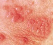 ʪѡҩǲܹȥhpv?