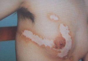 如何判断是否得了白癜风