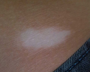 阴霾天气白癜风患者该如何护理