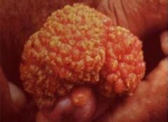 ʪʲôҩ﷽ܳ׸hpv?