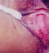 尖锐湿疣治疗总是反复患者怎么办?