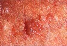 尖锐湿疣如何正确的使用外治药物?