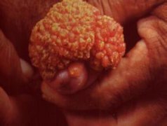 女性尖锐湿疣激光治疗后如何防复发?