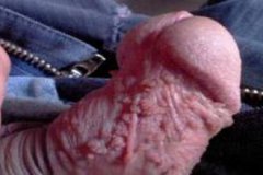 尖锐湿疣的治疗效果受到哪些因素的影响呢?