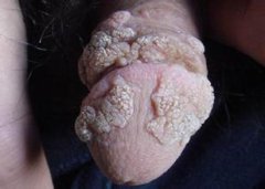 尖锐湿疣患者怎样正确的选择治疗药物呢?