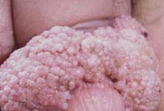 尖锐湿疣患者治疗时间如何防止病毒传染?