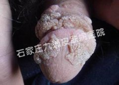 尖锐湿疣如何医治能更好的消除疣体?