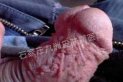 得了尖锐湿疣可用哪些药物消除症状损害?