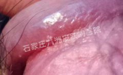 尖锐湿疣用哪些药物方法能治愈疣体损害?