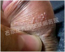 患上尖锐湿疣应当怎样治疗才可避免复发?