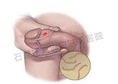 中医是如何具体治疗顽固尖锐湿疣的?