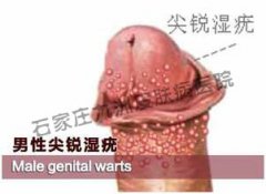 尖锐湿疣临床上如何具体的诊断呢?