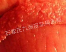 感染性病尖锐湿疣应当如何尽早治愈?