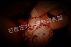 导致尖锐湿疣治愈后再复发的原因有哪些?