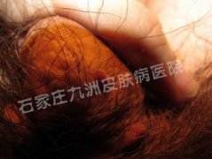 感染尖锐湿疣患者应当如何治疗预防呢?