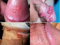 怀疑感染尖锐湿疣如何才能检查确诊呢?