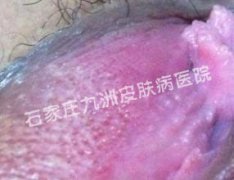 得了尖锐湿疣应当如何做好治疗选择呢?