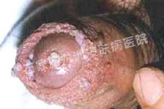 ʪhpv᲻ȾѪҺ?