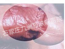 严重性尖锐湿疣应当如何治疗才好?