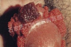 尖锐湿疣临床上的感染途径都有哪些?