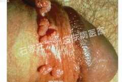 尖锐湿疣会对患者生活带来哪些影响?