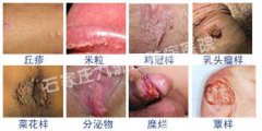 治疗尖锐湿疣可选的外药都有哪些?