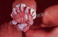尖锐湿疣治疗时应当注意哪些事情?