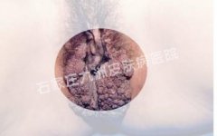 患者感染尖锐湿疣的原因都有哪些呢?