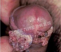 尖锐湿疣外治用哪些药物有好的效果呢?