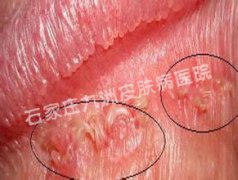 尖锐湿疣治疗再复发都是哪些内外因导致的?