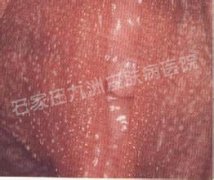 女性尖锐湿疣什么症状及如何治疗好呢?