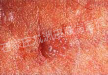 尖锐湿疣常规物理治疗能不能完全治愈?