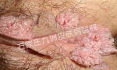 尖锐湿疣用什么方法外治可消除症状?