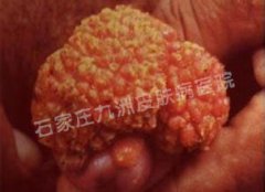患有尖锐湿疣应当怎么治疗才有效果?