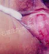 尖锐湿疣临床上能不能完全治好不复发?