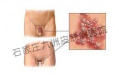 尖锐湿疣应怎样使用外药治疗才好呢?