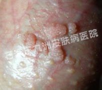 尖锐湿疣中医治疗用什么药物呢?