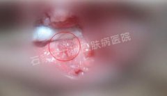 尖锐湿疣外药治疗会有哪些副作用伤害?