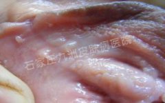 尖锐湿疣用哪种方法治疗可消除损害?