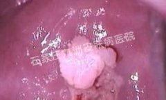 尖锐湿疣选择哪种物理方法能去除疣体?