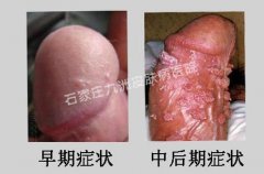 尖锐湿疣对患者健康生活带来哪些危害?