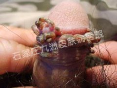 尖锐湿疣潜伏期时间男女患者一样吗?